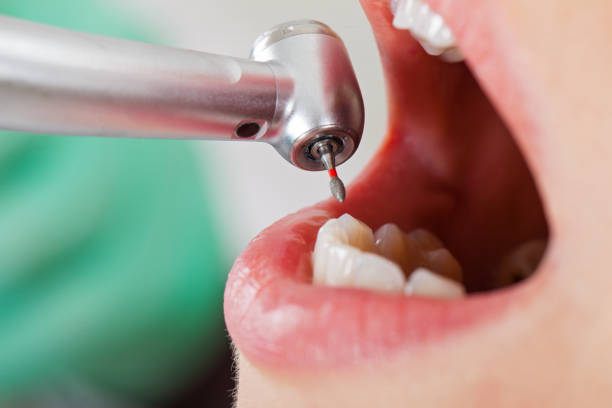 Best Emergency Root Canal Treatment in Mexico, MO